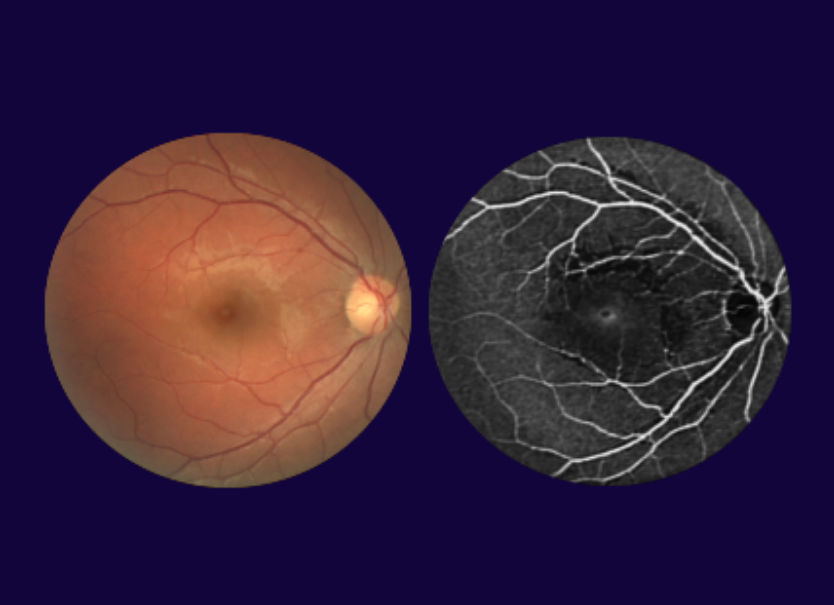 Retinal blood vessel segmentation result